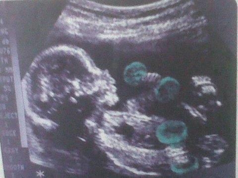 Update terhesség...