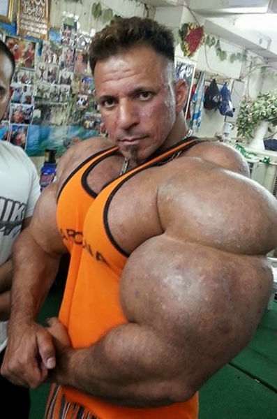 Synthol - olajat az izmokba?