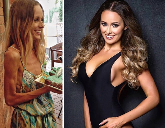 Anorexia - neki sikerült leküzdeni